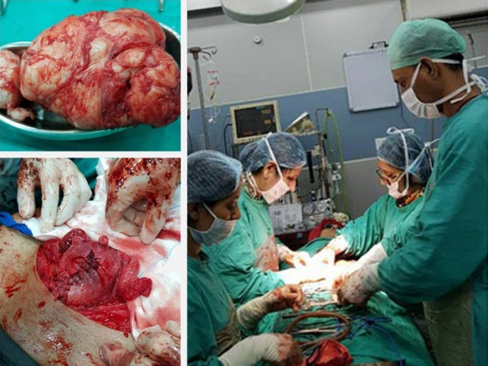 Large and multiple fibroids removed by Myomectomy preserving uterus