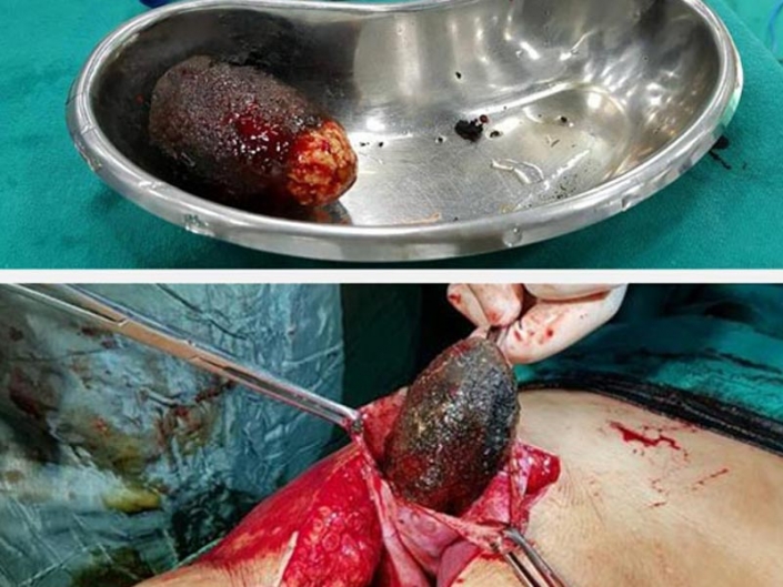 Successful operation of removing approximately 200 gm stone from gallbladder