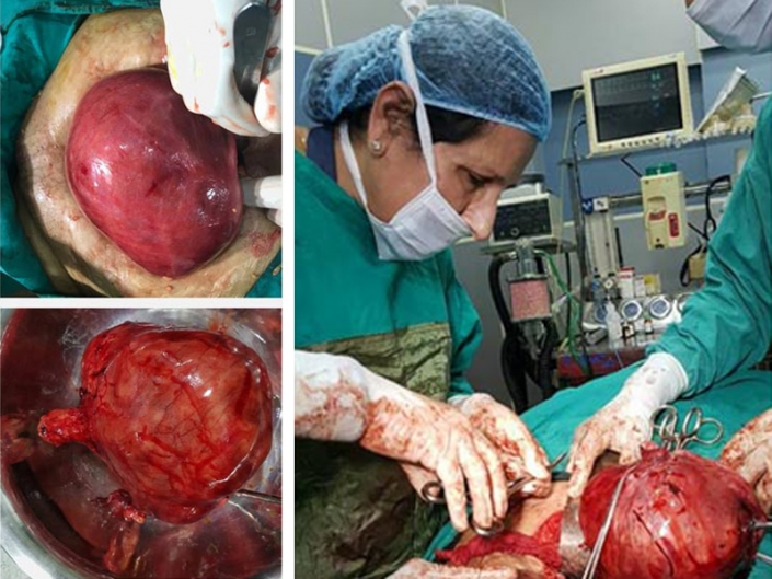 Uterine fibroid of approx 22 weeks size extracted